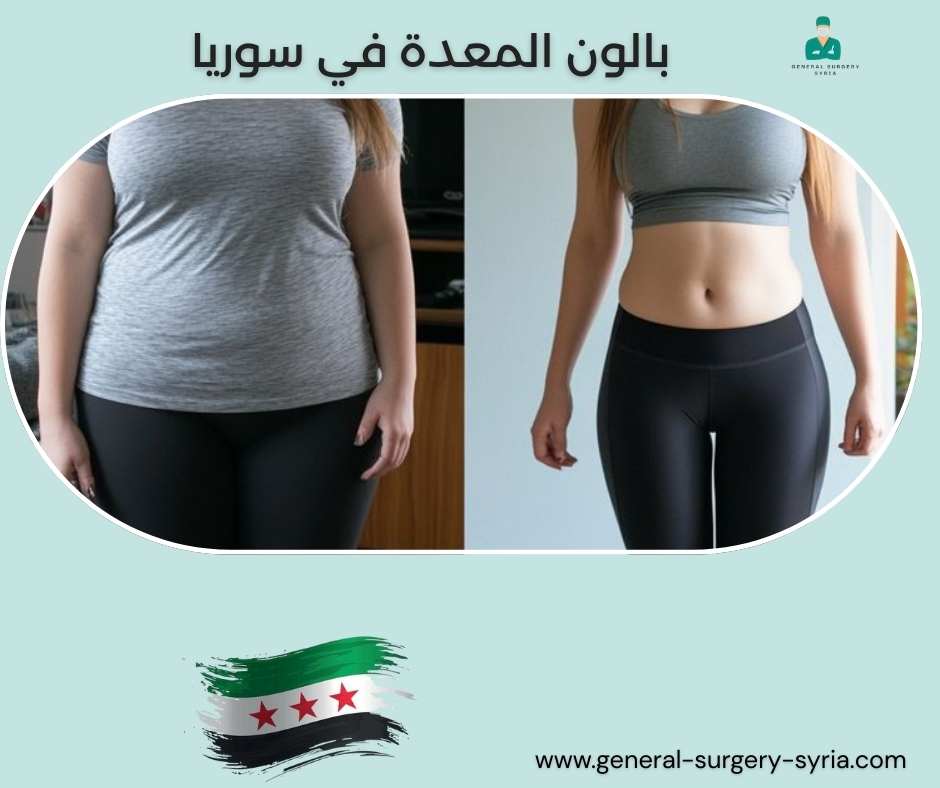 بالون المعدة في سوريا