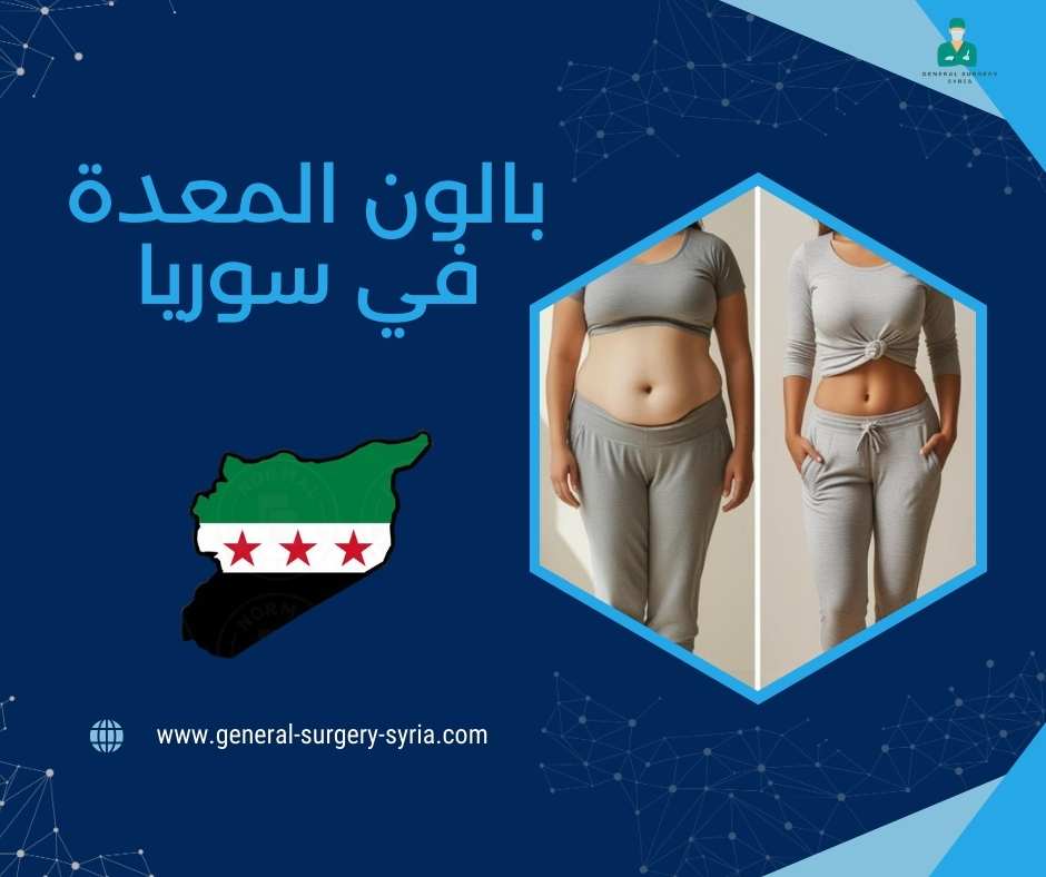 بالون المعدة في سوريا