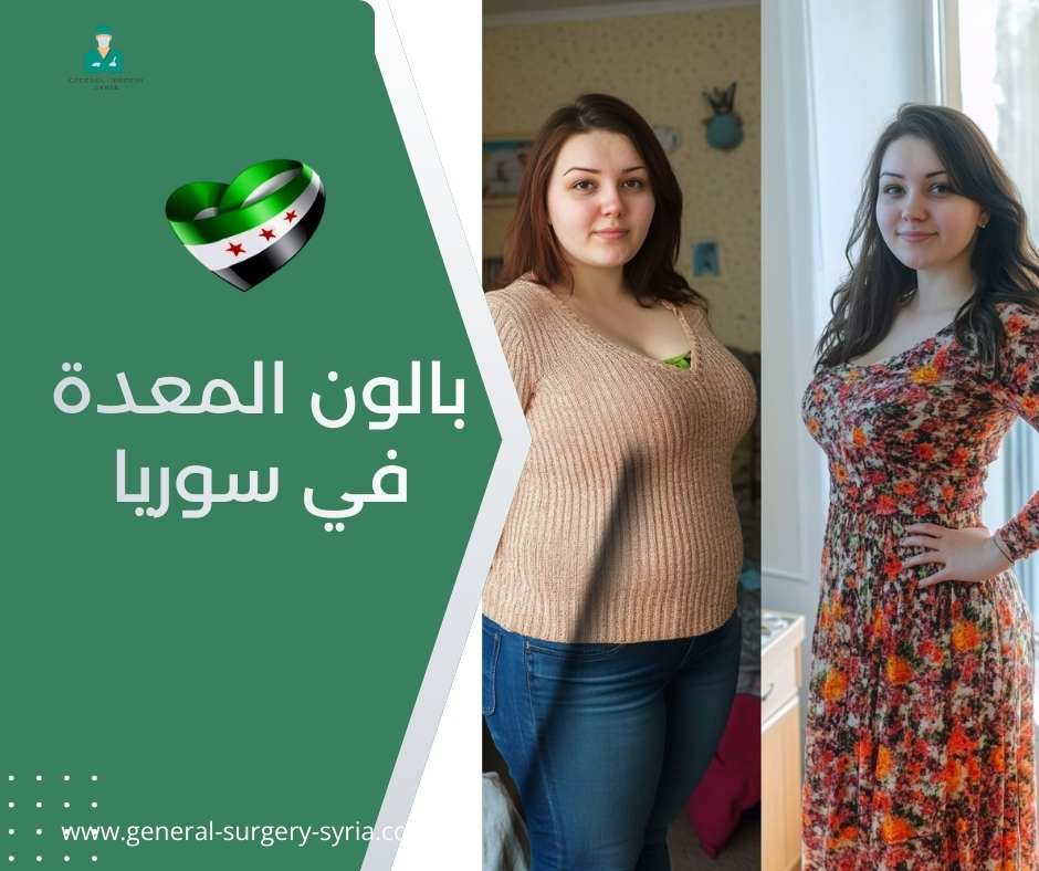 بالون المعدة في سوريا