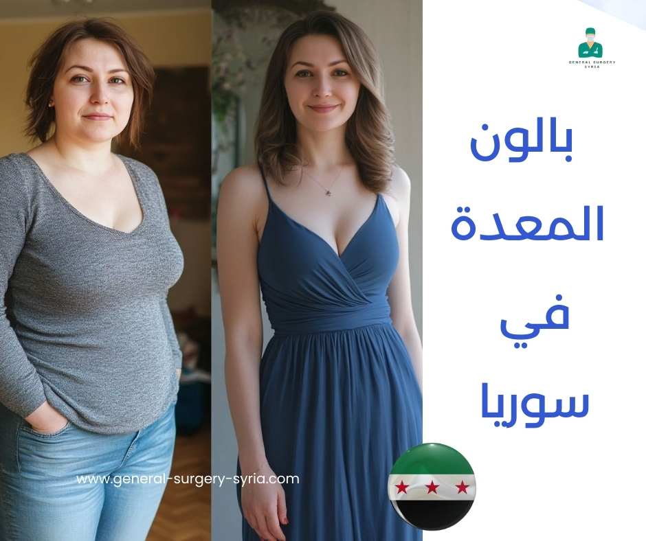 بالون المعدة في سوريا