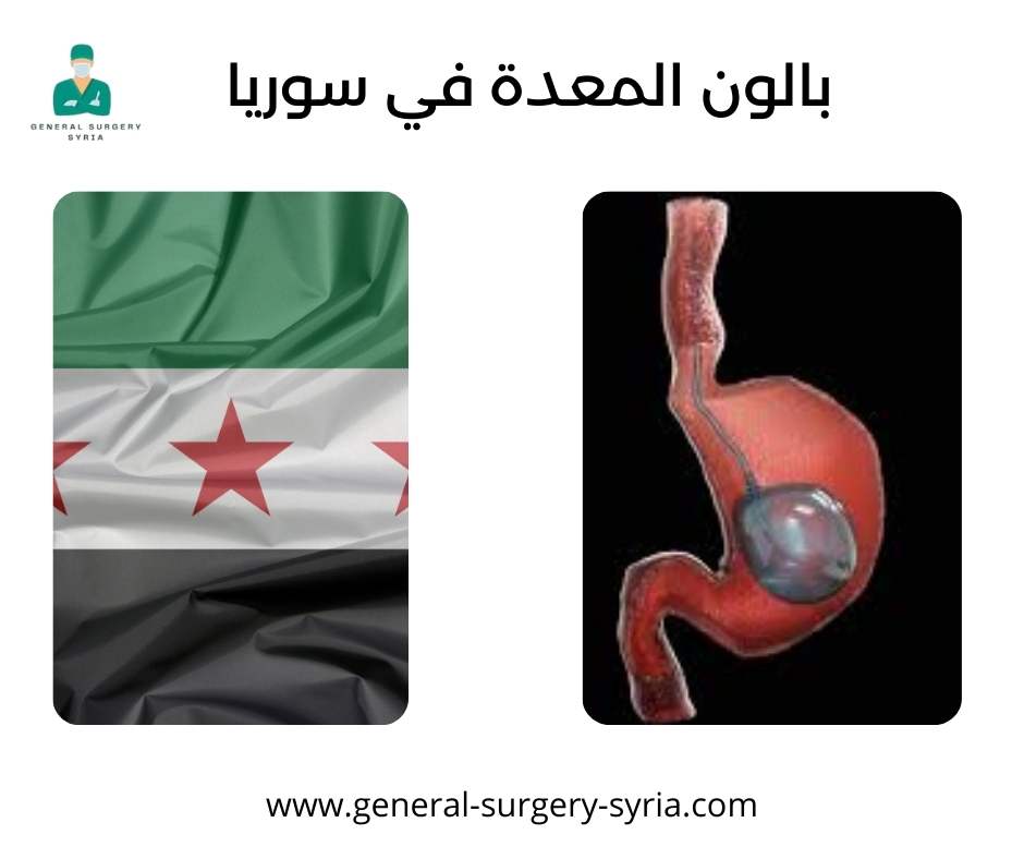 بالون المعدة في سوريا