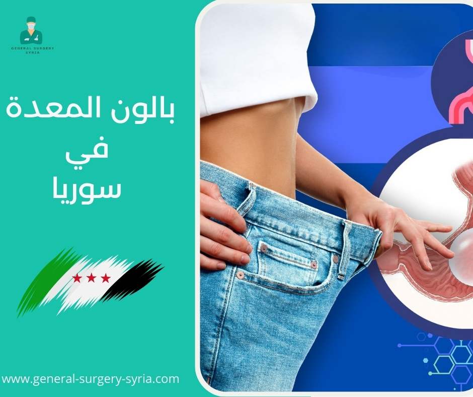 بالون المعدة في سوريا