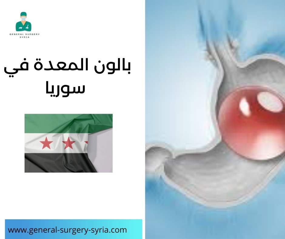 بالون المعدة في سوريا